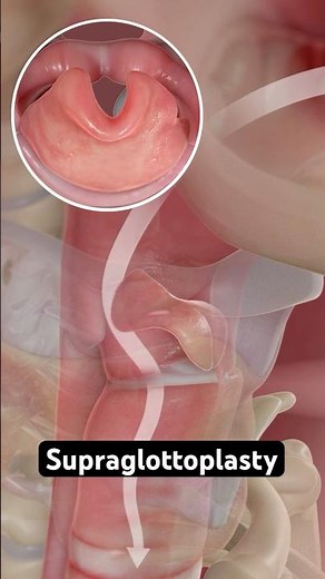Fixing a floppy epiglottis (3D Animation)