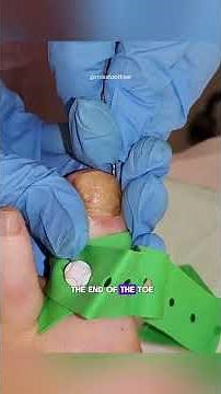 This patient has been living with toenail fungus for over 10 years 🦠