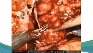 RALP: Nerve Sparing & Apex