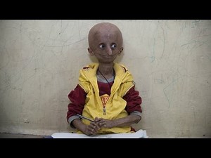 Teen With Progeria Ageing Syndrome Celebrates Milestone 15th Birthday