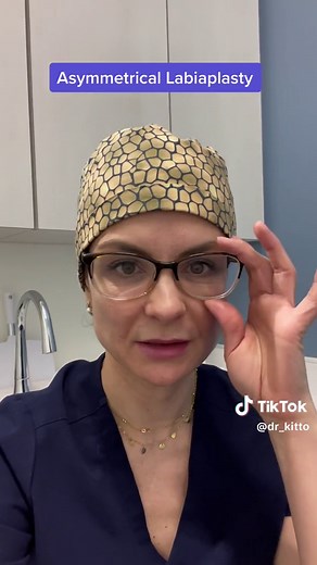 Labiaplasty for Asymmetry in RVA: Wedge Excision Procedure