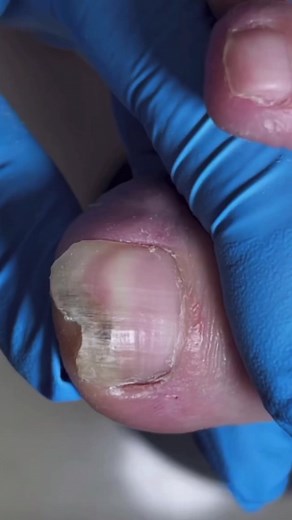 Deformed toenail cutting #fyp #fypシ #pedicure #ingrowntoenail @John Lewey