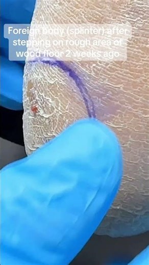 Foreign Body in the Foot #podiatry #foreignbody #splinter #footcaretips