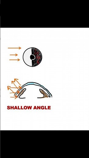 Angle Depth Assessment |Torch light Method #ophthalmology