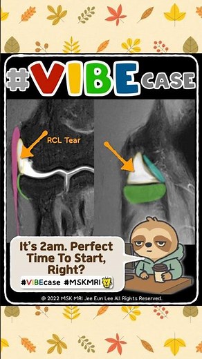 [VIBEcase] How to Spot a Radial Collateral Ligament Tear (Lateral Collateral Ligament Complex)