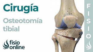 ¿Cómo se lleva a cabo la osteotomía tibial?