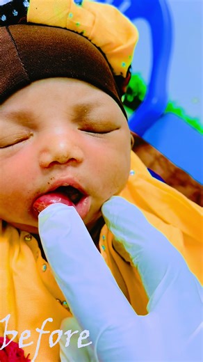 #ENT #drshariif @TAMAAM HOSPITAl before operation and after operation.