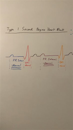 Second Degree Heart Block (Type I)
