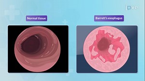 Video: Barrett Esophagus-II: Clinical Manifestations and Management