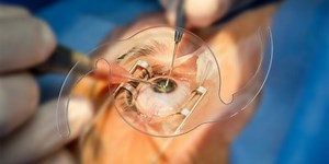 Advancements in Cataract Surgery: Expectations for Future Innovations and Shifts to Office-Based Procedures – Archyde