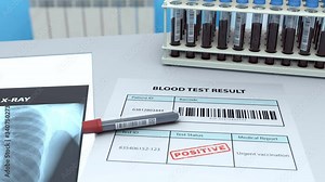 3D scene in the lab with a lung x-ray and a test tube with a blood test. Diagnosing the patient for coronavirus. Xray of the lungs shows pneumonia and inflammation of the lungs. Barcodes fake.
