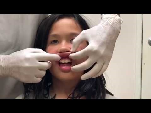 Frenectomy lip and tongue exercises tutorial