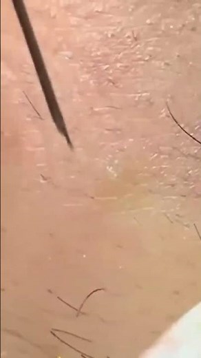 Acne Treatment NEW 2025 / blackheads and whiteheads removal #blackheads #acne #acnetreatment