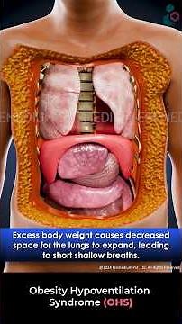 What is Obesity Hypoventilation Syndrome? ↪ 3D Medical Animations #OHS #Shorts #3DAnimation