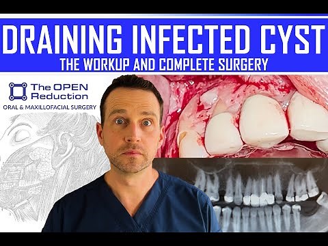 DRAINING an INFECTED JAW CYST #cystpoping