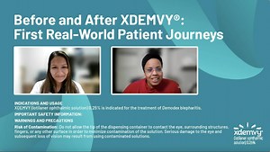XDEMVY: A Real Patient’s Experience with the Only FDA-Approved Demodex Blepharitis Treatment - Eyetube