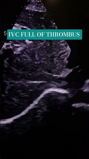 Large thrombus from ivc reaching into RV. IVC full of thrombus🫀👈 #thromboembolism #echocardiography