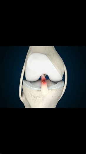 The Lachman test evaluates for ACL injuries. The knee is flexed to approximately 20–30 degrees. The examiner stabilizes the thigh with one hand while placing the other hand behind the proximal tibia and applies an anterior translational force to the tibia relative to the femur. Compare to the unaffected side. A positive examination is defined by increased anterior tibial translation greater than 2 mm, with or without a firm end point. Sensitivity 74 to 85%, specificity 83 to 95% 🔗👇 Link Below 