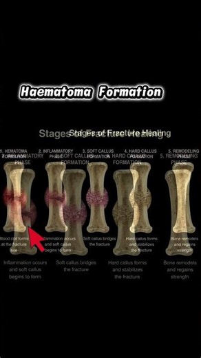 Stages of Fracture Healing #bonehealing #fracturehealing #boneinjury