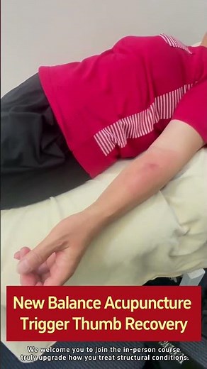 New Balance Acupuncture Trigger Thumb Recovery