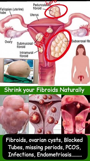 Do you need yonipearls? Do you have fibroids? Do you have serious menstralcramps ? Do you suffer from bacteriavaginoisis? Do you have overiancyst? Do you suffer from pid? Do you have pcos? Do you have blockedtubes? Do you have recurring yeastinfection, candida or UTIs? Have you failed to get pregnant? Do you have missingperiods? Do you have irregularperiods? Do you have heavyperiods? Do you have hormonal imbalance ? Do you suffer from infertility ? Do you have endometriosis? #yonipearls #yonidet