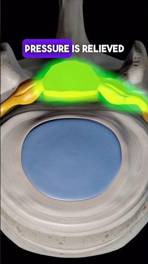 What is lumbar microdiscectomy ? #microdiscectomy #discbulges #sciatica #backpain #spinalstenosis