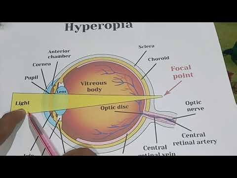 CAUSE OF HYPEROPIA AND ITS TREATMENT BY MEHTA SIR