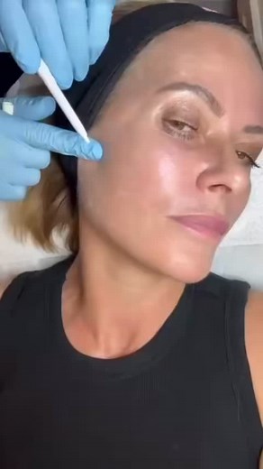 ✨ Sunekos Skin Booster ✨ Sunekos is an advanced injectable treatment that uses amino acids hyaluronic acid to stimulate your skin’s own collagen and elastin. It restores hydration, smooths fine lines, and brings back that fresh, youthful glow — all while keeping results natural. Perfect for: • Under-eye rejuvenation • Crepey skin • Fine lines wrinkles • Dull or dehydrated skin ✨ Brighten. Tighten. Revive. ✨ #Sunekos #SunekosSkinBooster #UnderEyeRejuvenation #SkinBoosters #CollagenStimulating #Bi