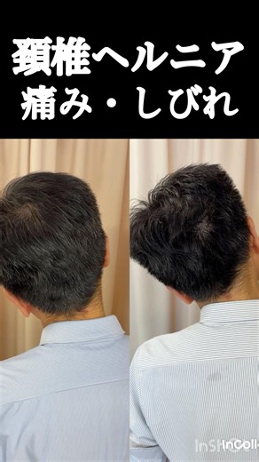 【"回復傾向"にある頚椎ヘルニア 首、肩、背中、腕、手指にかけて痛み・しびれ】病院で「ヘルニア」と診断されてもまだまだ諦めるな：広島県広島市中区の整骨院・整体院「かわら町整骨院」