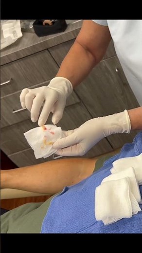 A Steatocystoma On The Forehead