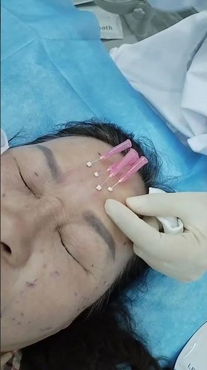 PDO threads for reducing forehead wrinkles