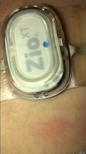 I Wore a ZIO XT Heart Monitor for 14 DAYS Straight! #zioxt #holtermonitor #shorts