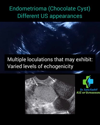 230 reactions · 45 shares | Ultrasound Endometrioma #ClinicalRadiology #asar #healthcare #radiology #FRCR #SCFHS #ultrasound | Sana Kashif | Facebook