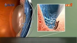 14 reactions | கண்புரை நோயும், தீர்வும் | RTM TV TamilSeithi | Facebook