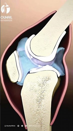Knee Arthritis Explained: The Basics to Take Control