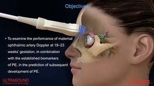 20K views · 396 reactions | Watch the new #UOGJournal video abstract on the role of maternal ophthalmic artery Doppler at 19–23 weeks in the prediction of pre-eclampsia, by Sapantzoglou et al. from Prof. Nicolaides’ group https://bit.ly/3sA4e3L | International Society of Ultrasound in Obstetrics and Gynecology (ISUOG) | Facebook
