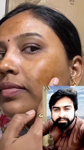freckles and spots on face disappear | Ahmad Rizvi ARS