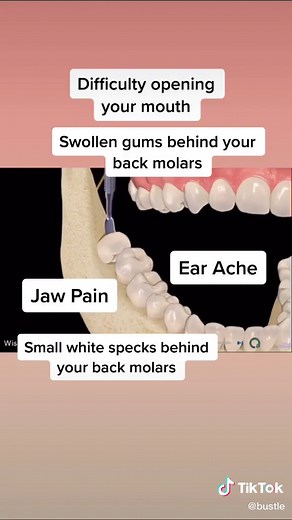 5 Signs Your Wisdom Teeth Are Coming In