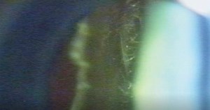 Posterior Vitreous Folds After Posterior Vitreous Detachment - Eyetube