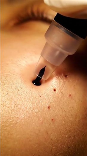 Ultra Macro Suction — Watch Filaments Lift Instantly! #YouTubeShorts #Explore #FilamentExtraction