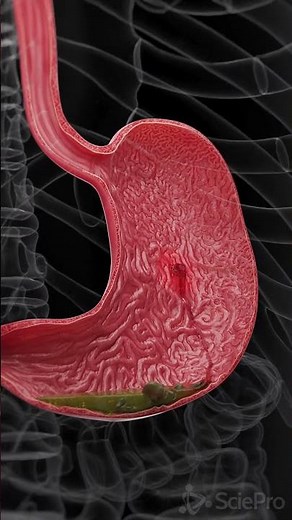 🔴 Understanding Bleeding Gastric Ulcers: A Serious Health Condition 🔴
