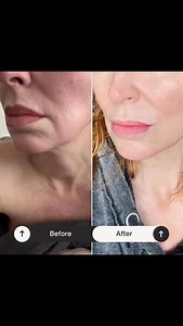 Erase your marionette lines naturally! 😍 Comment LINES and check your messages here for my brand NEW Marionette Line Eraser Daily Practice! Less than 10 minutes to reverse and prevent the lines from mouth corners down to jowls! It’s on Intro right now too - just $27! End Sunday at midnight so go scoop this! 🤯🙌🏻😍 you can use it on its own or with any other program you have from me as a way to accelerate your more challenging areas. I’ll see you there, Sadie ♥️ This reel is for women struggli
