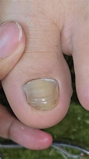 Ginamitan ko na ng malaking nipper sa kapal ng kuko #kaingrownnglaguna | ka ingrown ng laguna