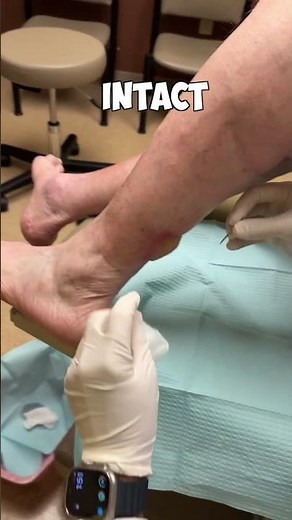 Popping a Blister!😳😬#shorts