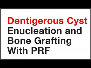 Dentigerous Cyst Enucleation and Bone Grafting With PRF By Dr Girish Rao