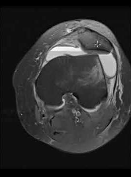 Patellar dislocation