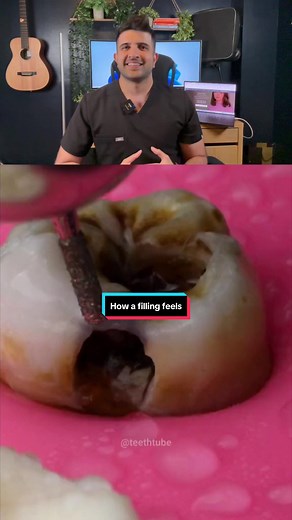Understanding the Filling Process at the Dentist