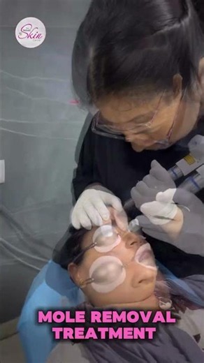 Mole Removal Treatment – Safe & Painless Procedure by Dr. Asma Parveen 👩‍⚕️ | The Velvet Skin Centre