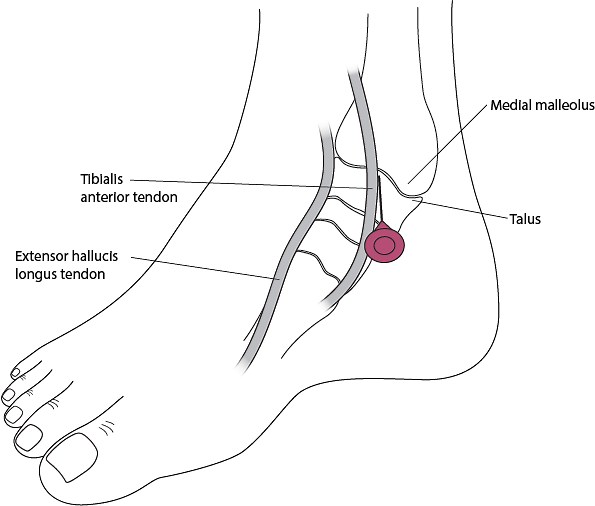 How To Do Ankle Arthrocentesis - Rheumatology and Orthopedics - MSD Manual Professional Edition