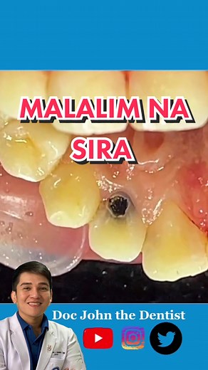 Mahalaga ang Pagsasaayos ng Malalim na Sira ng Ngipin